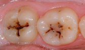 CARIES-1.jpg