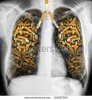 stock-photo-x-ray-of-a-human-thorax-with-effects-of-cigarette-smoking-lung-cancer-154687589.jpg