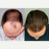 Hair-Transplant-before-4824981-3018545.png